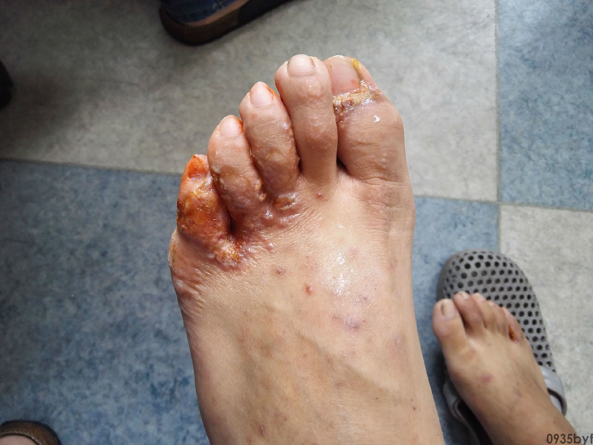 感染脚气的脚是怎样的(图1) 感染脚气的脚是怎样的