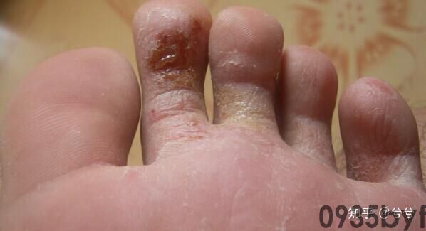 足癣糜烂型用什么药(图1) 足癣糜烂型用什么药