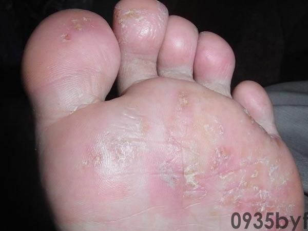 脚上长一片片的水泡(图1) 脚上长一片片的水泡