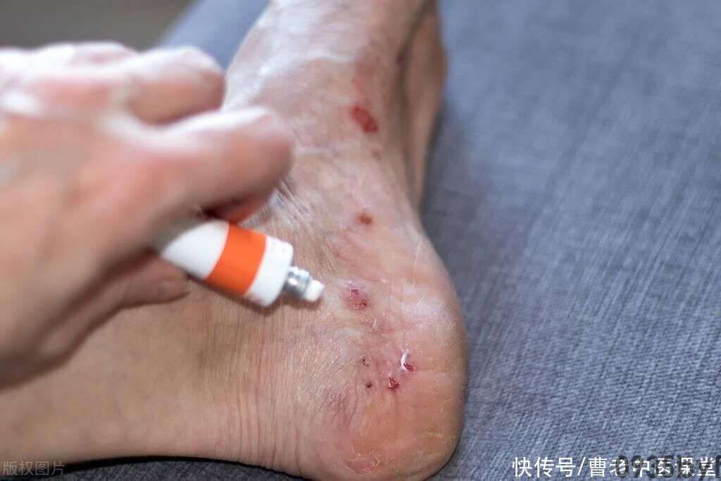 脚上有红斑是怎么回事?(图1) 脚上有红斑是怎么回事?