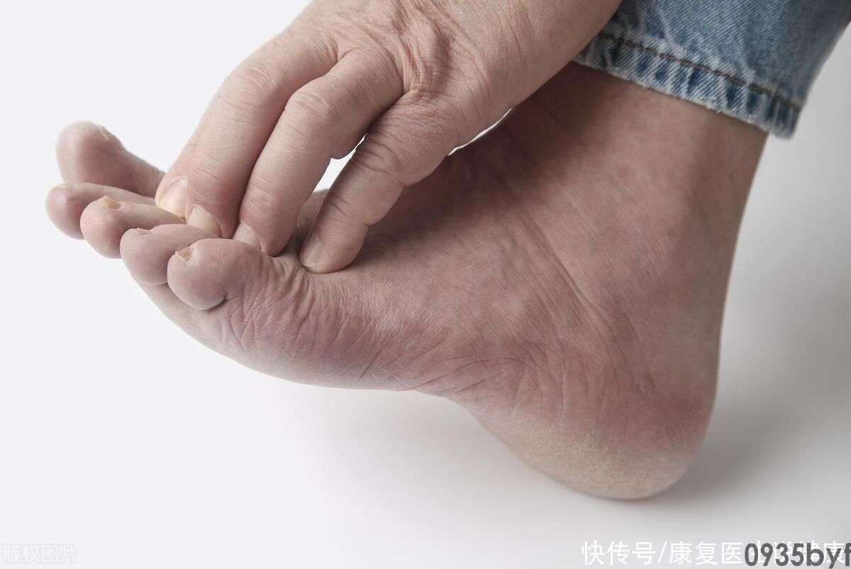 有脚气怎么调理(图1) 有脚气怎么调理