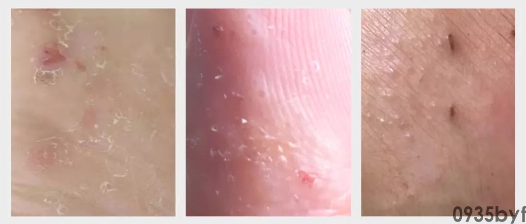 治脚气用什么药?(图1) 治脚气用什么药?