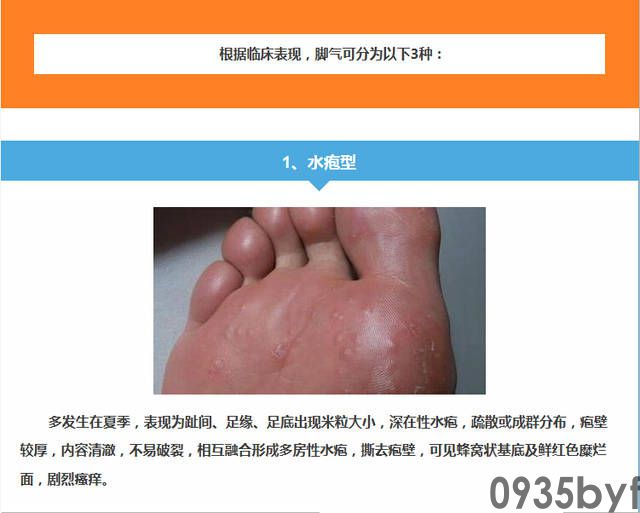糜烂型脚气的症状(图1) 糜烂型脚气的症状