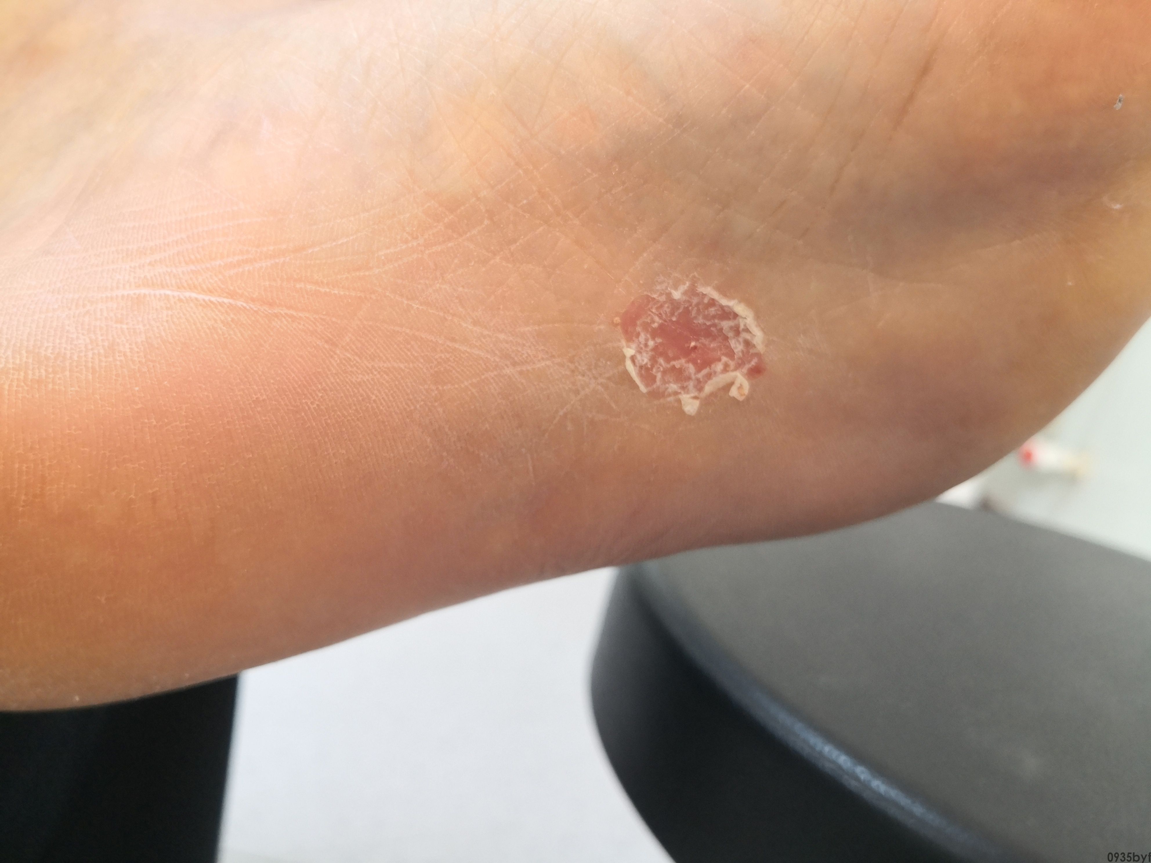 脚气干裂脱皮(图1) 脚气干裂脱皮