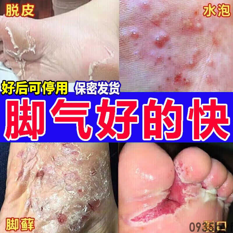脚气溃烂怎么治-有来医生(图1) 脚气溃烂怎么治-有来医生