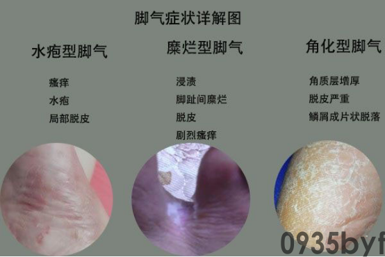 糜烂型脚气怎么治什么药好(图1) 糜烂型脚气怎么治什么药好