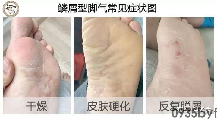 脚气症状-有来医生