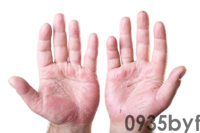 脚痒特别是晚上越抓越痒是脚气吗