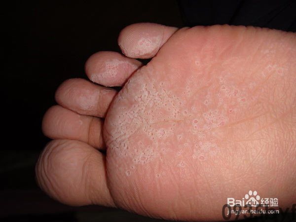 怎样治疗水疱型脚气