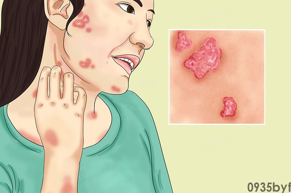 红斑狼疮是啥病(图1)