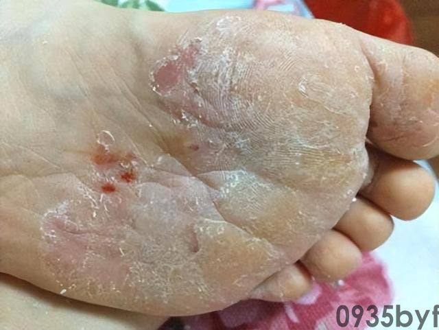 脚气病和脚气的区别