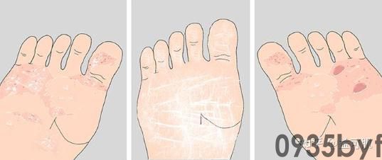 脚气分哪几种类型(图1) 脚气分哪几种类型