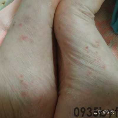 脚气的症状表现是什么(图1) 脚气的症状表现是什么