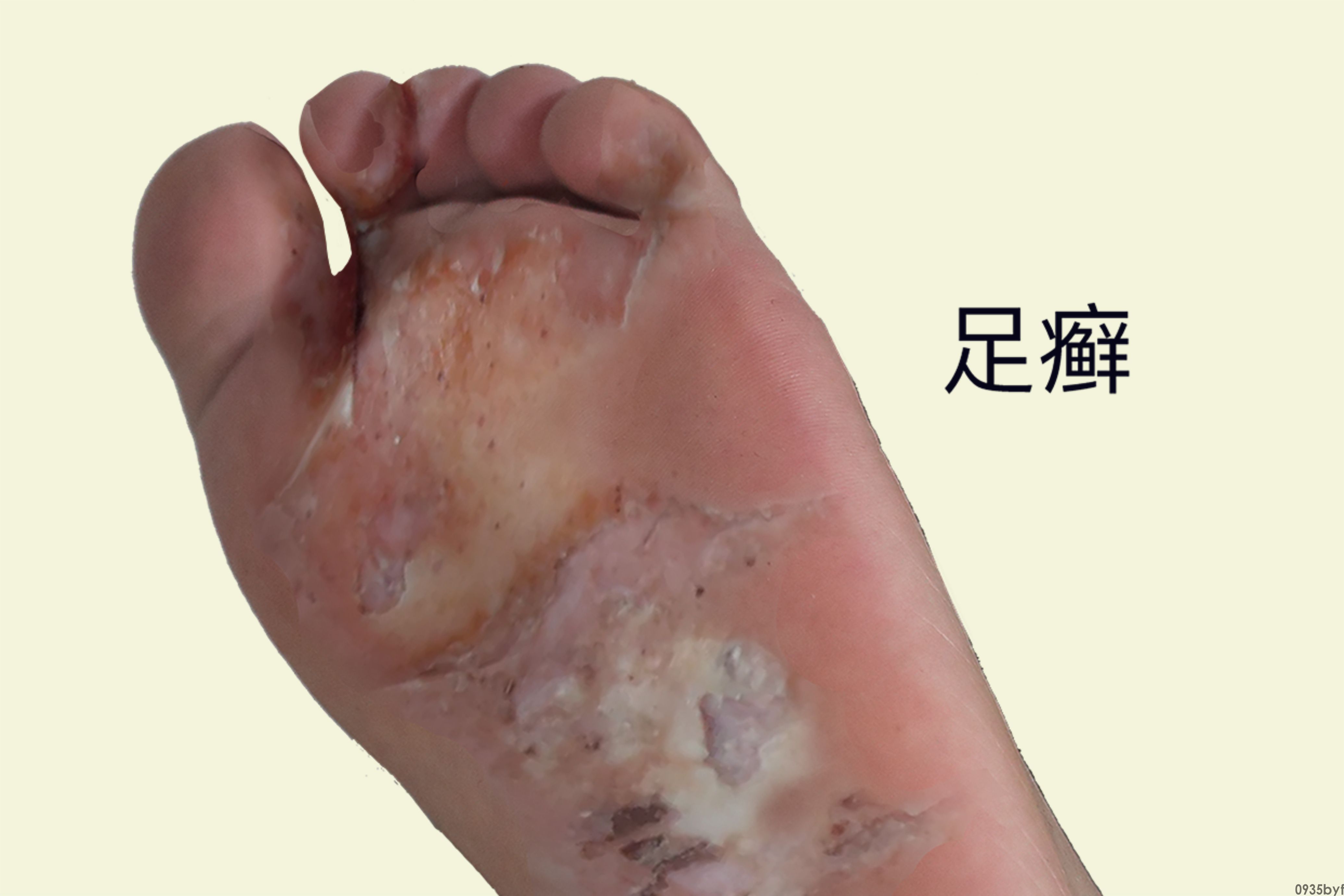 脚癣图片(图1) 脚癣图片(图1)