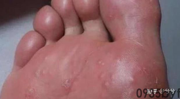脚后跟起皮是脚气吗(图1) 脚后跟起皮是脚气吗