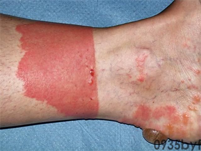 红色痘印怎么消除(图1) 红色痘印怎么消除