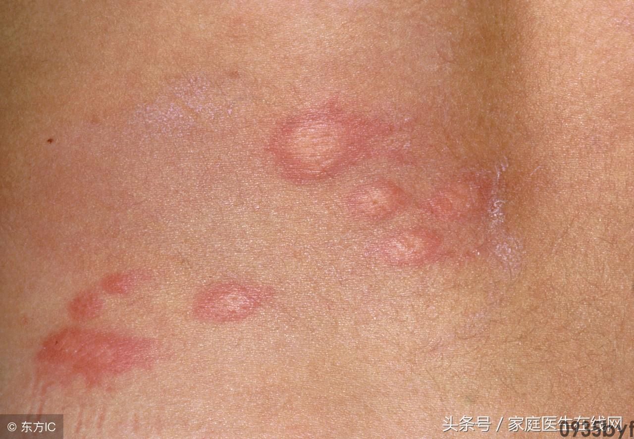 阴茎上有红斑怎么回事(图1) 阴茎上有红斑怎么回事