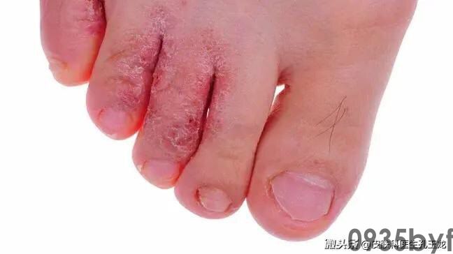 脚底脱皮是脚气吗