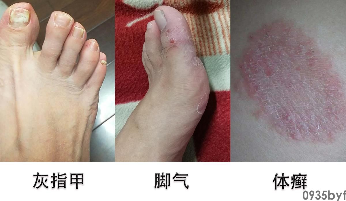 什么是丘疹鳞屑型和水泡型足癣？