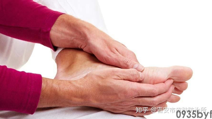 脚气治疗过程中存在哪些误区(图1) 脚气治疗过程中存在哪些误区