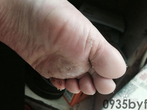 水疱型脚气用什么药-有来医生(图1) 水疱型脚气用什么药-有来医生