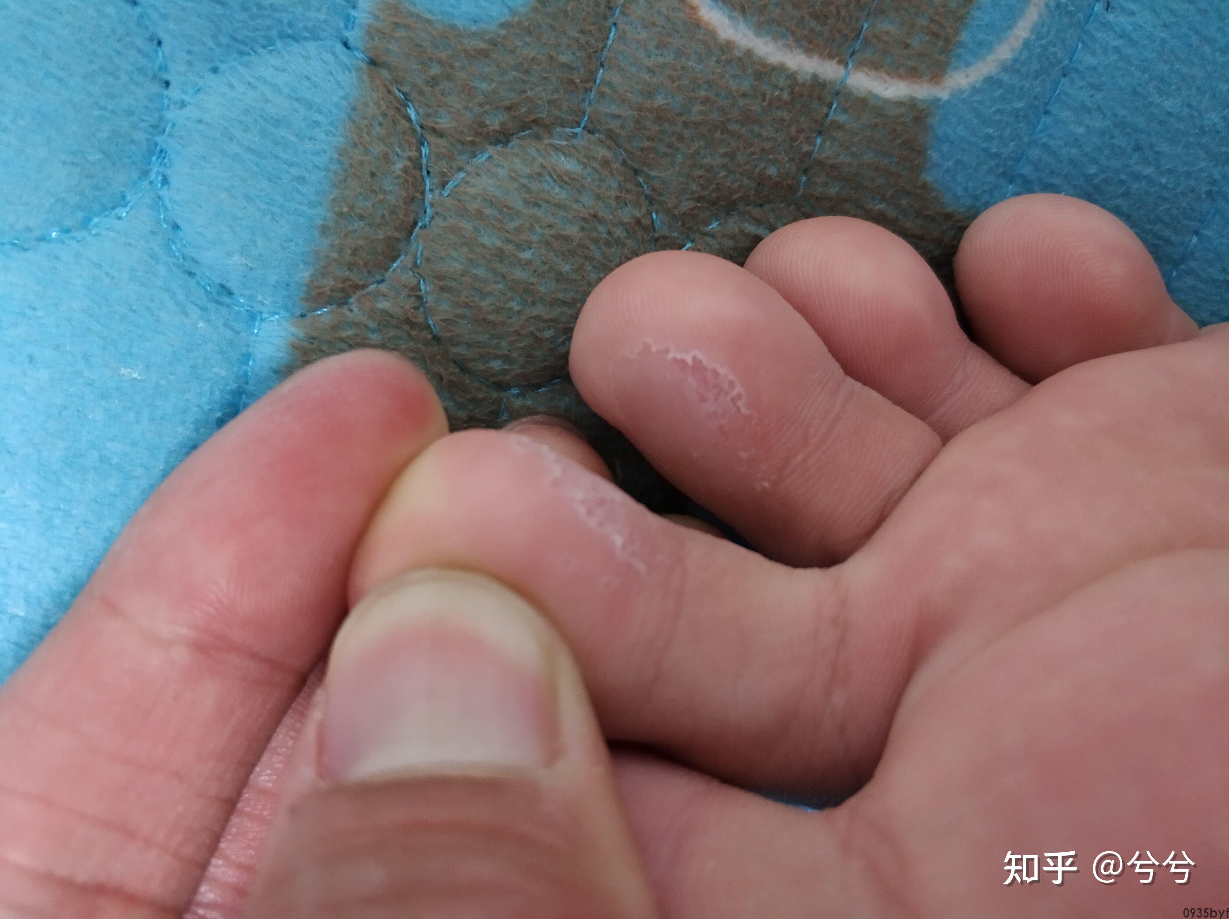 糜烂萎缩性胃炎传染吗(图1) 糜烂萎缩性胃炎传染吗