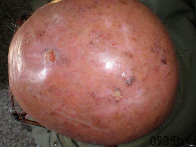 常见皮肤疾病典型图片汇总(图7) 常见皮肤疾病典型图片汇总(图7)