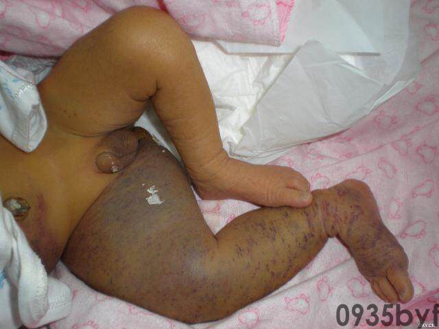 常见皮肤疾病典型图片汇总(图4) 常见皮肤疾病典型图片汇总(图4)