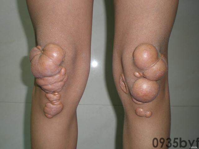 常见皮肤疾病典型图片汇总(图2) 常见皮肤疾病典型图片汇总(图2)