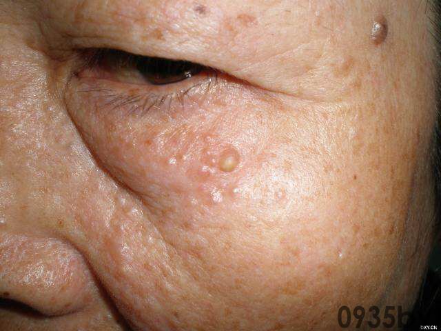 常见皮肤疾病典型图片汇总(图1) 常见皮肤疾病典型图片汇总(图1)