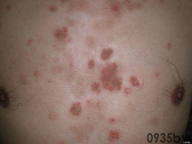 常见皮肤疾病典型图片汇总(图8) 常见皮肤疾病典型图片汇总(图8)