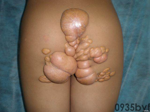 常见皮肤疾病典型图片汇总(图3) 常见皮肤疾病典型图片汇总(图3)