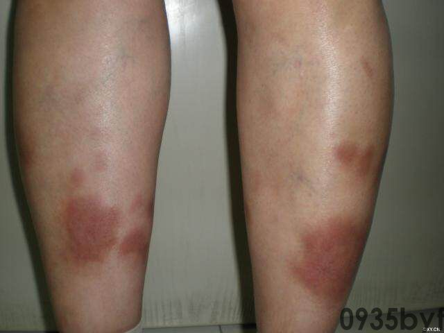 常见皮肤疾病典型图片汇总(图6) 常见皮肤疾病典型图片汇总(图6)