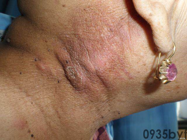 常见皮肤疾病典型图片汇总(图9) 常见皮肤疾病典型图片汇总(图9)