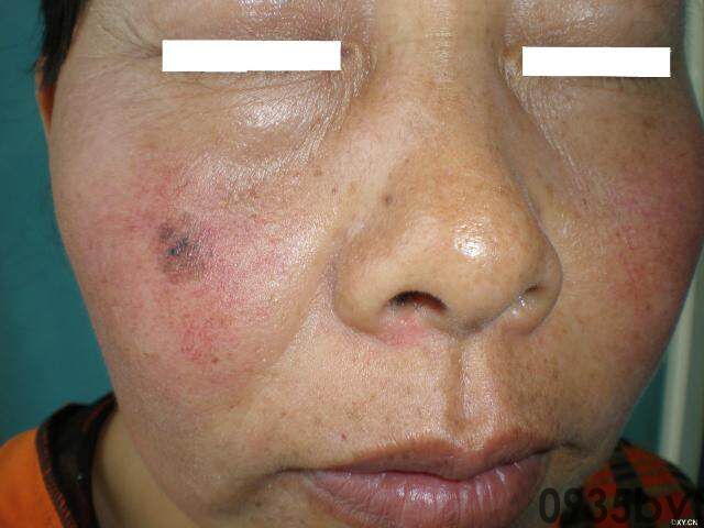 常见皮肤疾病典型图片汇总(图11) 常见皮肤疾病典型图片汇总(图11)