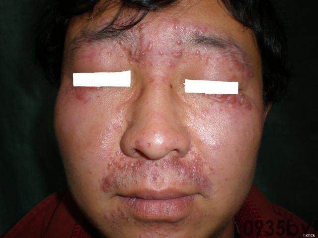 常见皮肤疾病典型图片汇总(图14) 常见皮肤疾病典型图片汇总(图14)