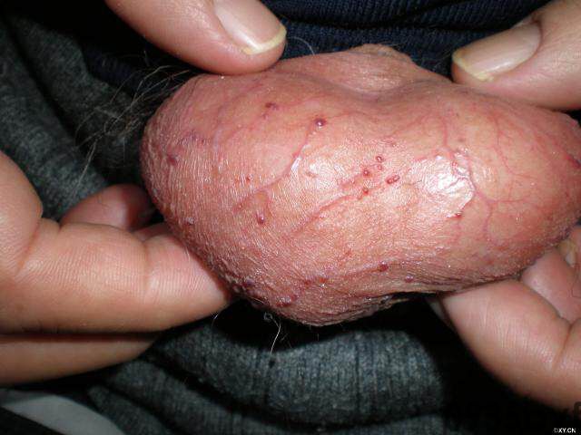 常见皮肤疾病典型图片汇总(图13) 常见皮肤疾病典型图片汇总(图13)