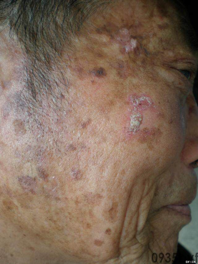 常见皮肤疾病典型图片汇总(图18) 常见皮肤疾病典型图片汇总(图18)