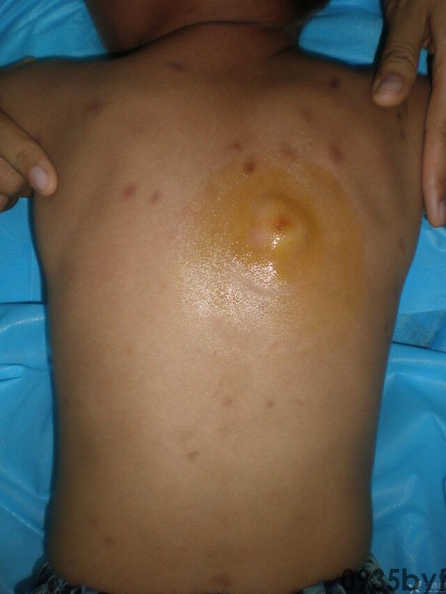 常见皮肤疾病典型图片汇总(图19) 常见皮肤疾病典型图片汇总(图19)