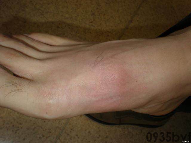 常见皮肤疾病典型图片汇总(图12) 常见皮肤疾病典型图片汇总(图12)