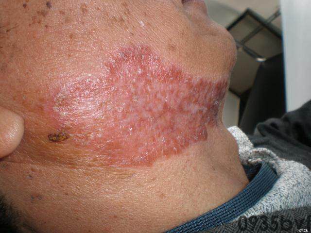 常见皮肤疾病典型图片汇总(图15) 常见皮肤疾病典型图片汇总(图15)