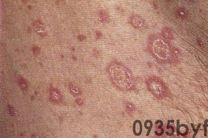 红斑是什么症状图片怎么治(图3) 红斑是什么症状图片怎么治(图3)