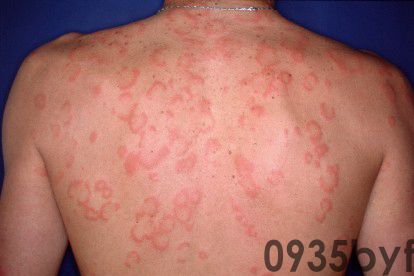 红斑是什么症状图片怎么治(图1) 红斑是什么症状图片怎么治(图1)