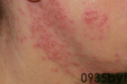 红斑是什么症状图片怎么治(图2) 红斑是什么症状图片怎么治(图2)