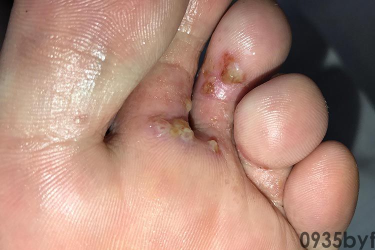 脚上出小水泡是什么类型的脚气(图1) 脚上出小水泡是什么类型的脚气