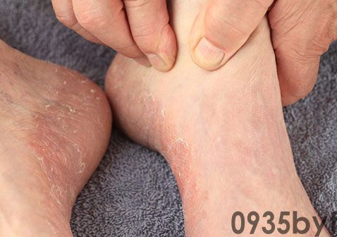 脚气怎么治(图1) 脚气怎么治