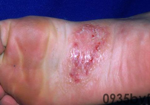 足癣:你不可忽视的真菌感染看看怎么办!(图1) 足癣:你不可忽视的真菌感染看看怎么办!