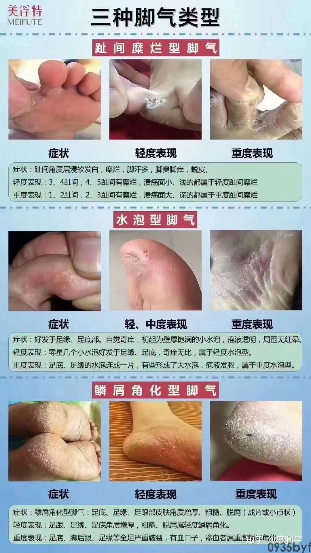 水疱型足癣脚上有暗红色疙瘩图-有来医生