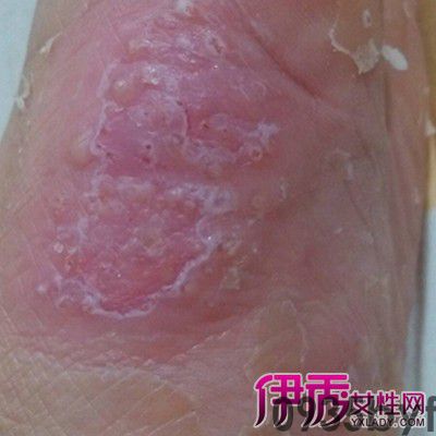 水泡型脚气怎么治疗用什么药最好?(图1) 水泡型脚气怎么治疗用什么药最好?