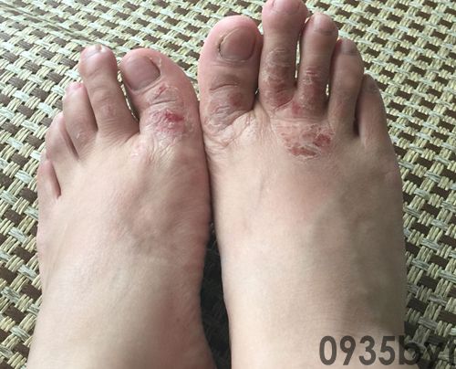 糜烂型脚气用什么药最好(图1) 糜烂型脚气用什么药最好